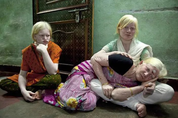 白化病宝宝成幼儿园最受欢迎女孩