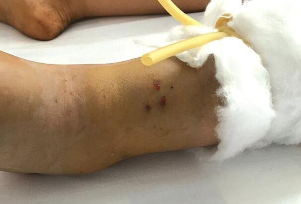 广东惠城区水口惊现14斤眼镜王蛇，不小心被被蛇咬之后该怎么办？